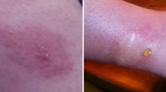 Спав: шкода та наслідки укусу